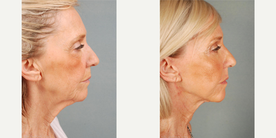 Facial Fat Transfer before and after photo