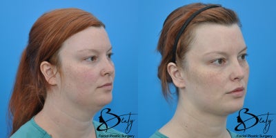 Neck Lift before and after photo
