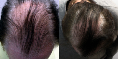 PRP for Hair Loss before and after photo