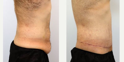 Tummy Tuck before and after photo