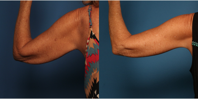 Arm Lift before and after photo
