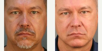 Facelift before and after photo