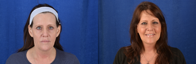 Facelift before and after photo