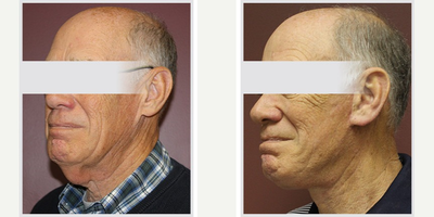 Neck Lift before and after photo
