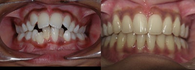 Braces before and after photo