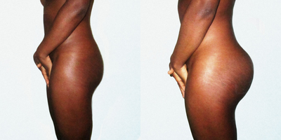 Butt Implants before and after photo