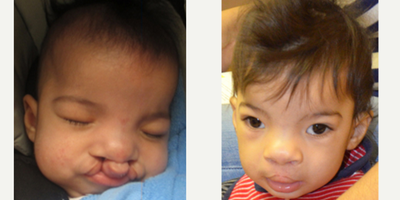 Cleft Lip And Palate Repair before and after photo