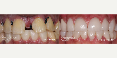 Dental Crown before and after photo