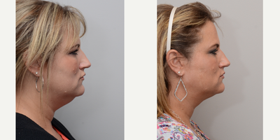 Liposculpture before and after photo