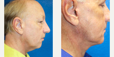 Neck Lift before and after photo