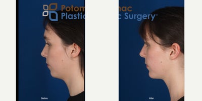 Neck Lift before and after photo