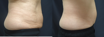 SculpSure before and after photo