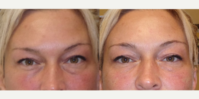 Juvederm before and after photo