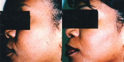 Laser Resurfacing before and after photo