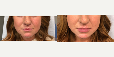 Lip Fillers before and after photo
