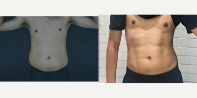 Liposuction before and after photo