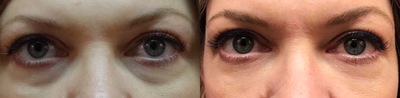 Restylane before and after photo