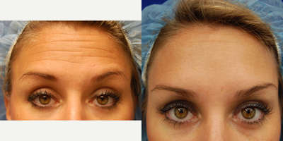 Botox before and after photo