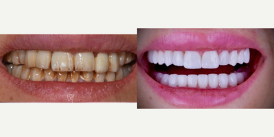 Dental Crown before and after photo
