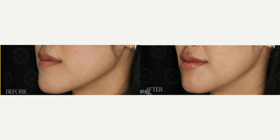 Lip Fillers before and after photo