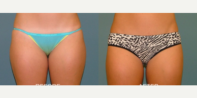 Liposuction before and after photo