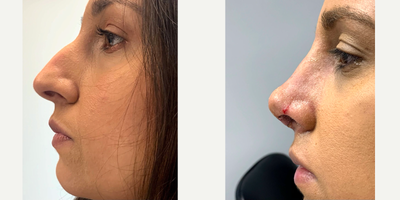 Rhinoplasty before and after photo