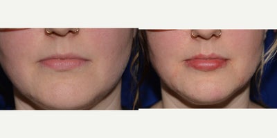 Lip Fillers before and after photo