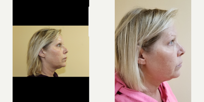 ThermiTight before and after photo