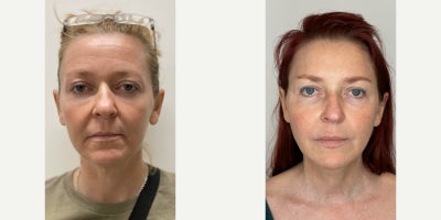Hair Loss Treatment before and after photo