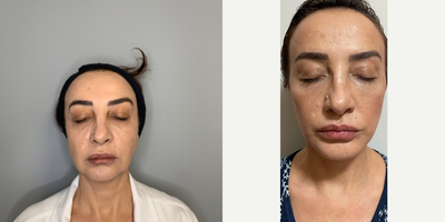 Neck Lift before and after photo