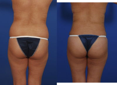Brazilian Butt Lift before and after photo