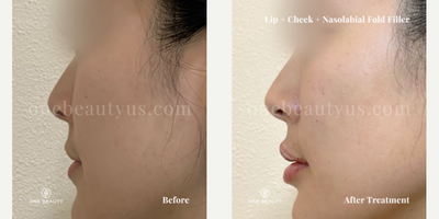 Cheek Fillers before and after photo