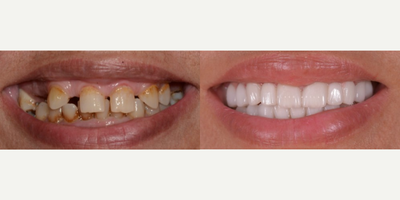 Dental Crown before and after photo