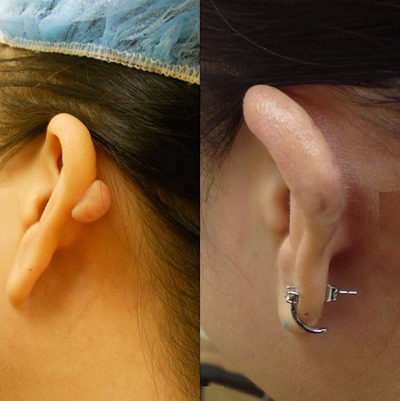 Ear Surgery before and after photo