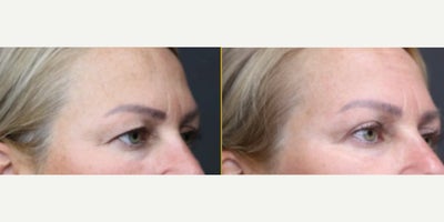 Eyelid Surgery before and after photo