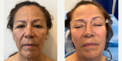Facelift before and after photo