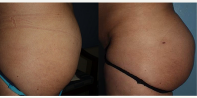 Brazilian Butt Lift before and after photo