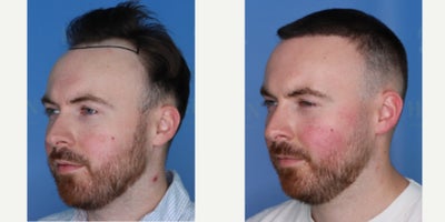 FUE Hair Transplant before and after photo