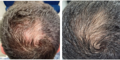 Hair Loss Treatment before and after photo