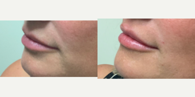 Juvederm before and after photo