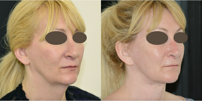 Facelift before and after photo