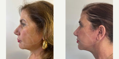 Facelift before and after photo