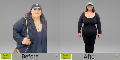 Gastric Sleeve Surgery before and after photo