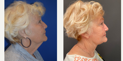 Neck Lift before and after photo