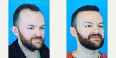 Hair Transplant before and after photo