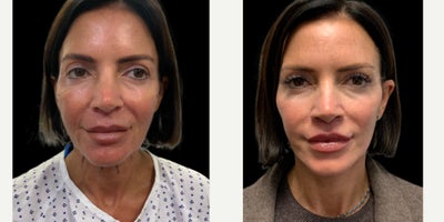 Neck Lift before and after photo