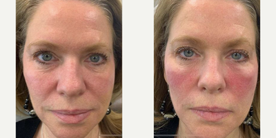 PRP Injections before and after photo