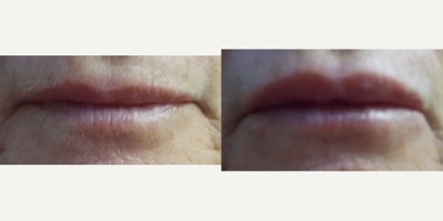 Restylane before and after photo