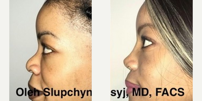 Revision Rhinoplasty before and after photo