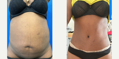 Vaser Liposuction before and after photo